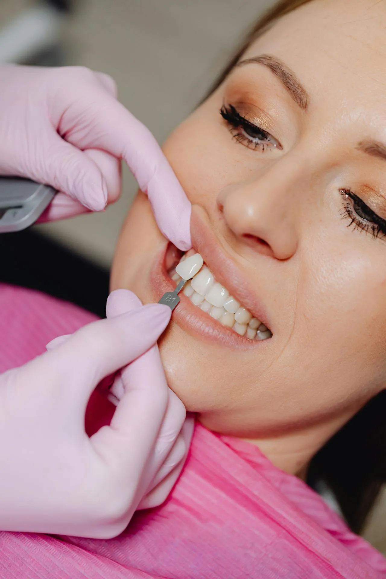 Hollywood smile design procedure in progress at a top Antalya cosmetic dentistry clinic — Digital Smile Design technology for precision aesthetic planning